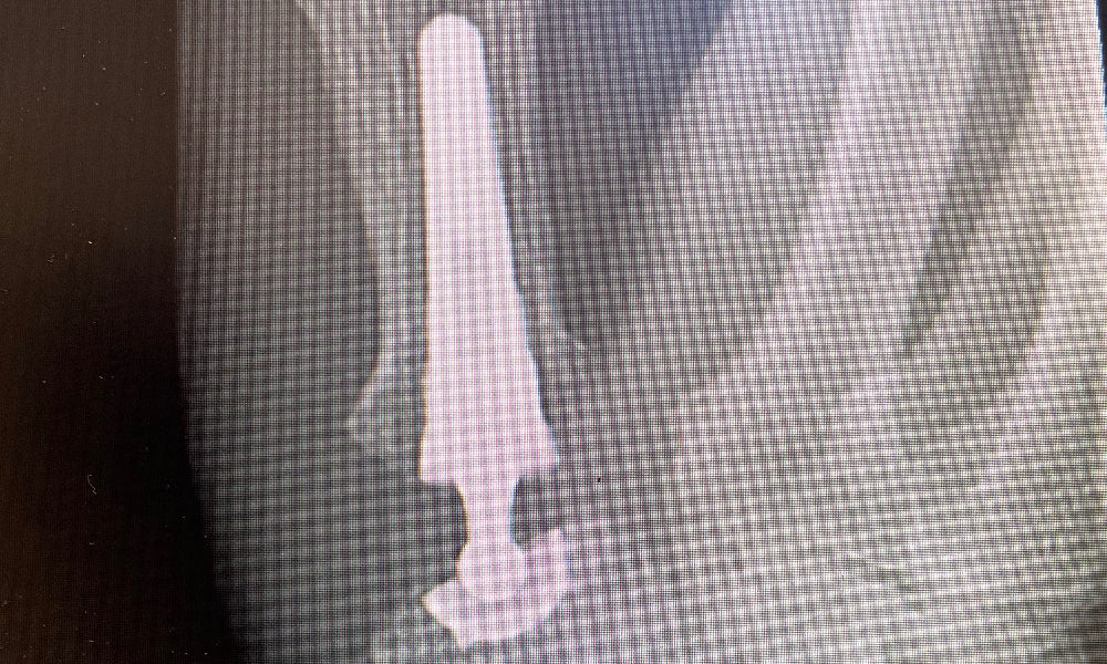 MAIA joint replacement